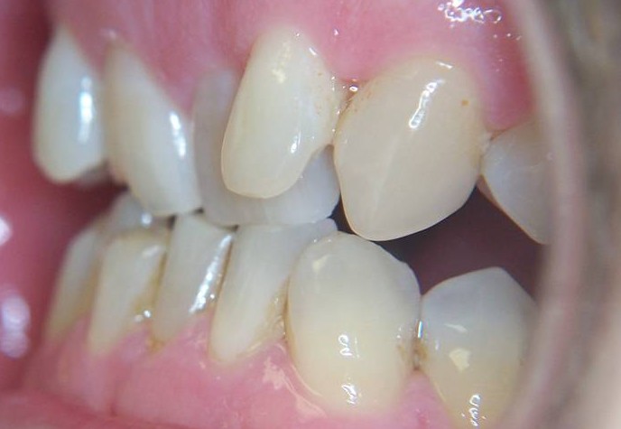 are crooked teeth unhealthy